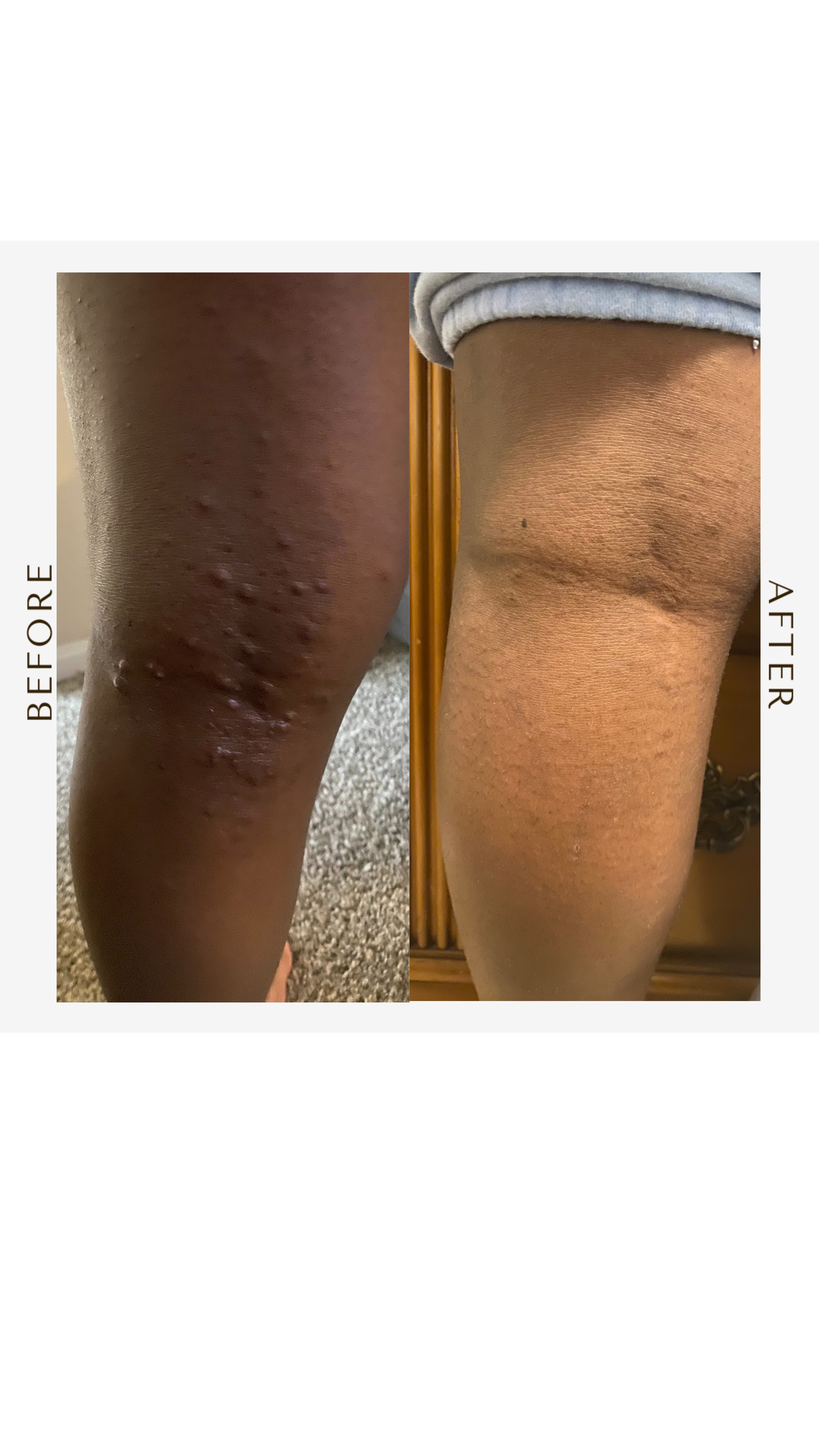 Eczema + Psoriasis Reversal Oil